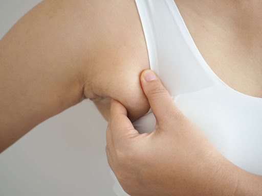 Singapore’s Complete Guide On Armpit Fat & Axillary Accessory Breasts Tissue