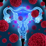 Ovarian cancer vs. cervical cancer
