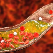 How to treat blockages in the coronary arteries