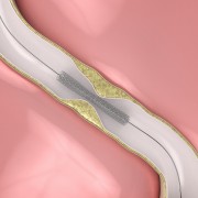 First absorbable stent approved by FDA