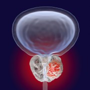 Detecting prostate cancer early can boost survival