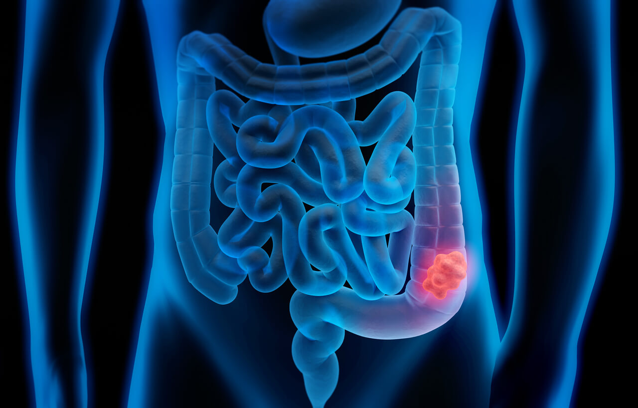 Colorectal cancer can be beaten